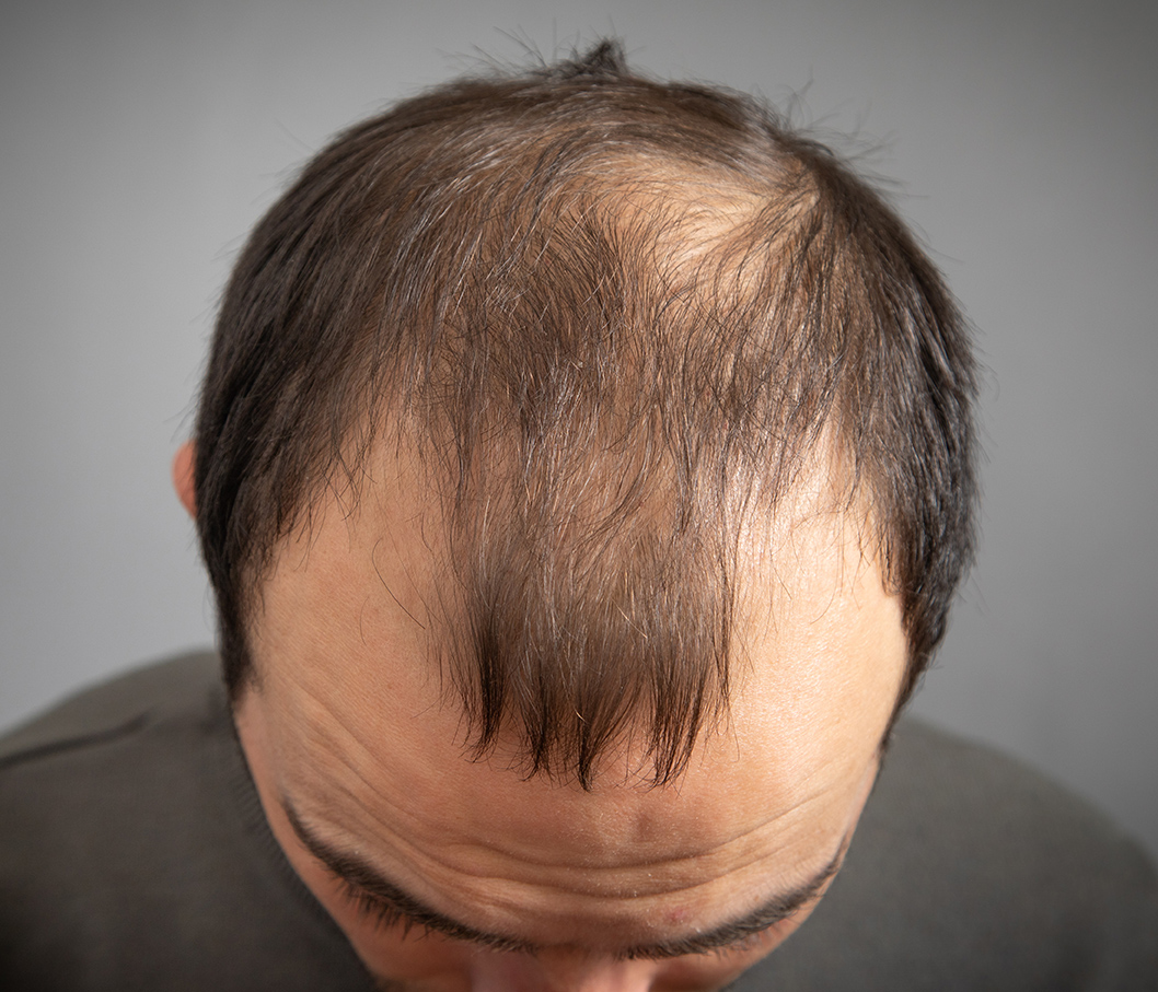 Stops Hair Loss Concern